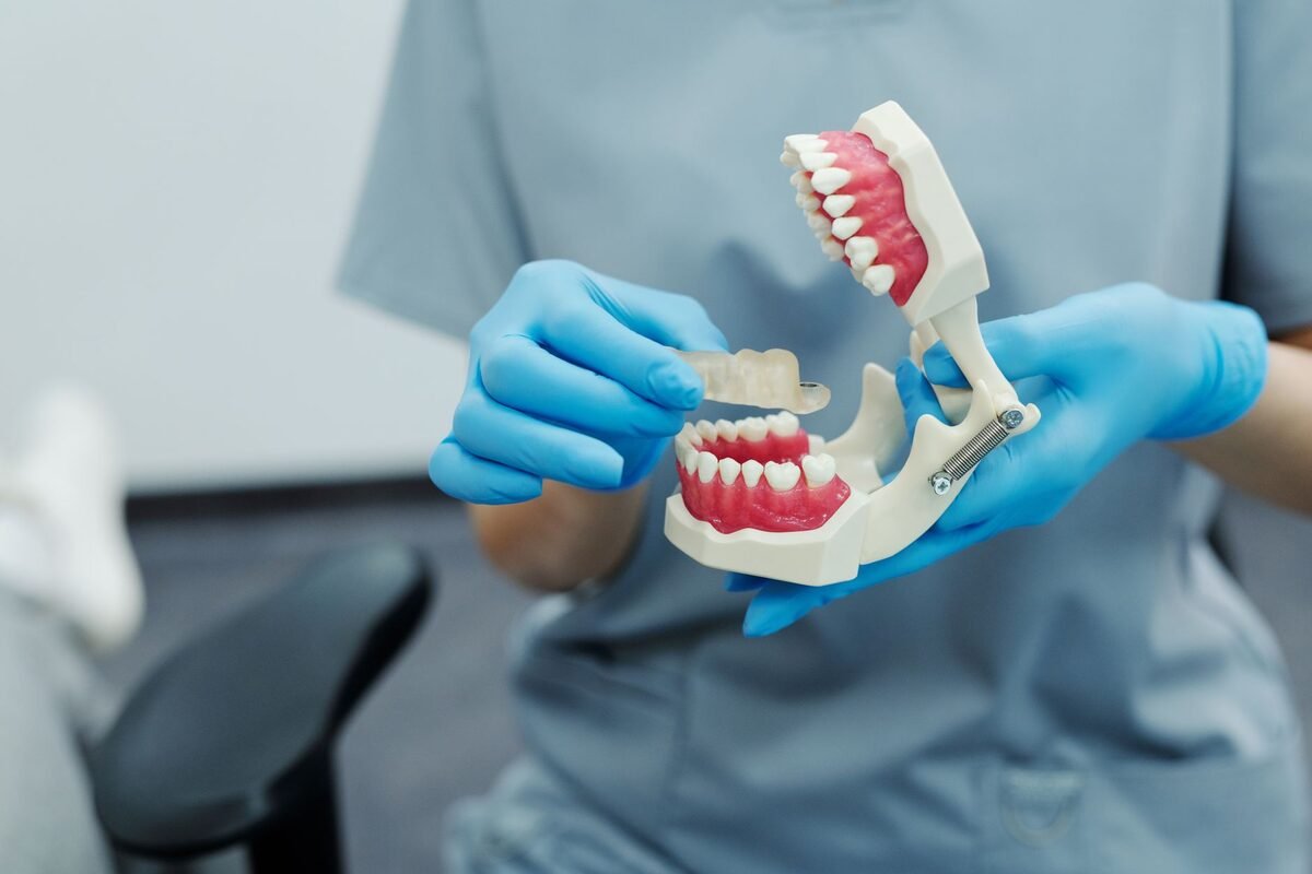 Full-Arch Implants